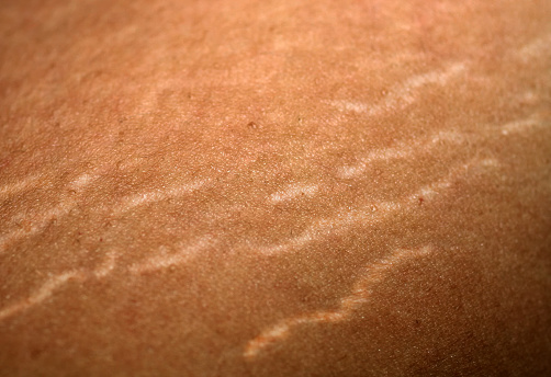Stretch marks on the skin. Scars on the body. Stretch marks on legs. Cellulite